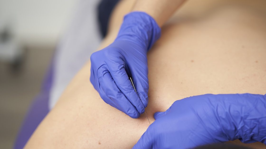 Physiotherapist applying dry needling to a patient's shoulder at our Bolton clinic