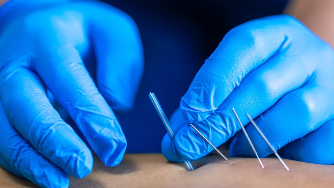 Gloved physiotherapist inserting fine dry needling filament needles into a patient's muscle during treatment at Rehab Genius Health Preston